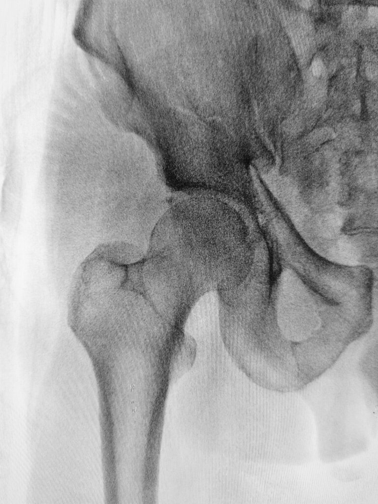 X-ray of hip